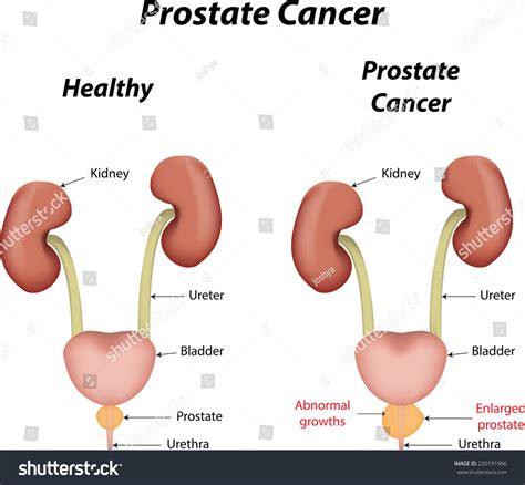 Prostate Cancer Stock Vector Illustration 230191966 : Shutterstock