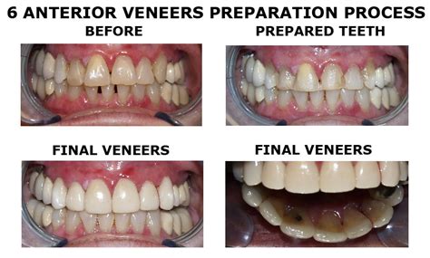 Porcelain Veneers | My Family Dentist