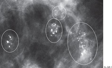 Multiple Clusters of Crushed Stone-like Calcifications on the Mammogram Produced by Malignant ...