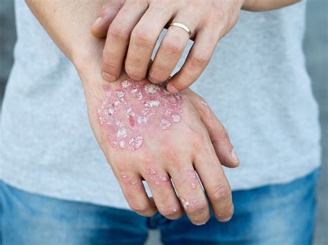 Psoriasis - Symptoms, Causes, Treatment and Photos