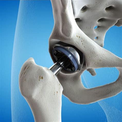 Hip Surgery Austin, TX - Orthopaedic Specialists of Austin