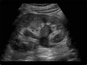 Pyelonephritis Ultrasound Findings: generalized or focal swelling of ...