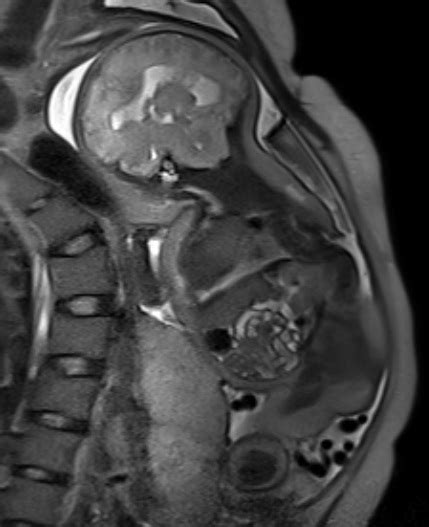 RADIOLOGY ACM With Meningomyelocele and CCA / Sacral agenesis MRI