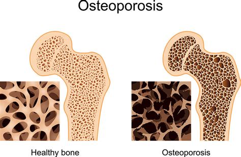 Osteoporosis-x850 - H-Wave