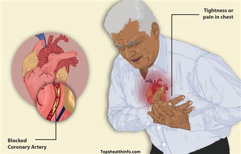 Angina Pectoris: Symptoms, Causes & Treatment (at Germany)