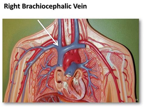 Brachiocephalic Veins; Innominate Veins