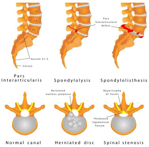 spine-fracture-spondylolysis-spondylolisthesis-is-a-defect-in-the-bony-ring-comprising | EP ...