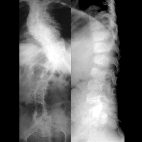 Diastrophic Dysplasia | Pediatric Radiology Reference Article | Pediatric Imaging | @pedsimaging