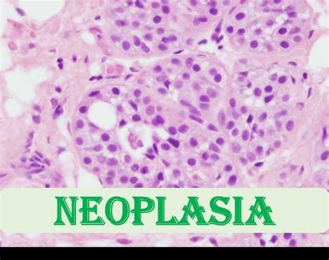 Neoplasia Types, Components And Nomenclature |MedbooksVN : r/usmle