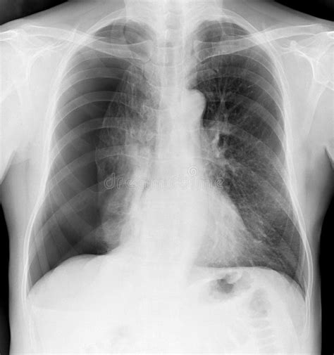 X-ray of the Chest of a Man with a Pneumothorax Stock Image - Image of ...