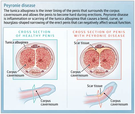 peyronie's disease treatment near me - demarcus-cavalli