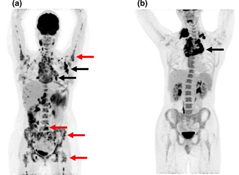 Lymphoma On Ct Scan | Hot Sex Picture