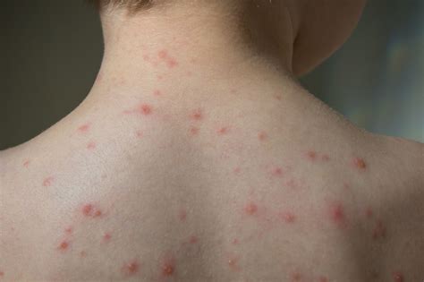 Varicella Rash After Vaccine