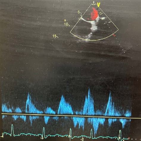 Transesophageal echocardiogram pre-procedure, severe pulmonary venous... | Download Scientific ...