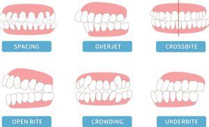 Process Of Getting Braces - Step-By-Step Guide