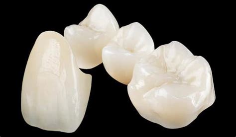 Dental Crowns Bridges Advanced Dentistry Of Richmond