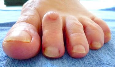 Orteils en griffe à Lyon - Chirurgie du pied - Hallux Valgus