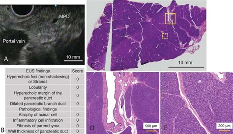 A representative case without abnormal EUS or pathological findings ...