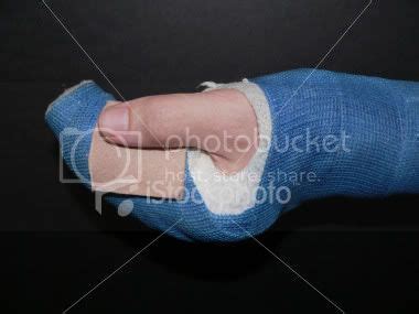 ist2_344731-broken-hand-cast.jpg Photo by jsenglishmetrocastnet | Photobucket