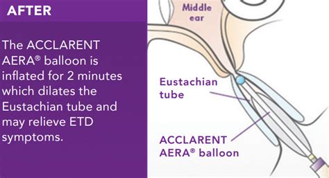 Eustachian Tube Dysfunction Chicago | Hearing Loss Chicago