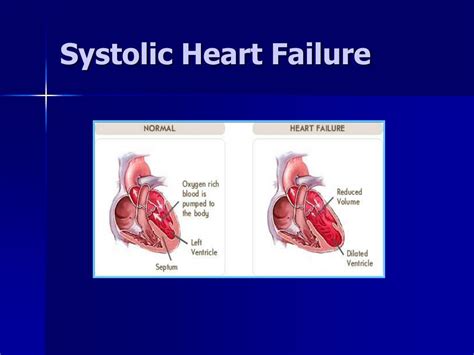 PPT - Systolic and Diastolic Heart Failure PowerPoint Presentation ...