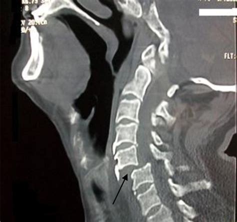 CT scan of cervical spine revealing partial anterior sublaxation (C5... | Download Scientific ...