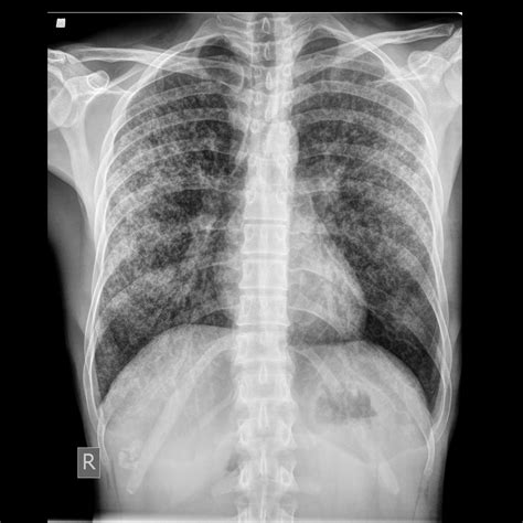 Miliary tuberculosis | Image | Radiopaedia.org