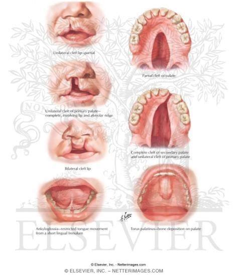 torus palatinus - Google Search | Oral cavity, Oral, Board exam