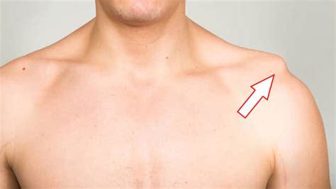 Shoulder Separation: Symptoms, Causes, Treatment By Shoulder Separation ...