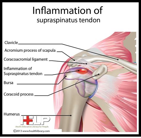 Inflammation of Supraspinatus Tendon | Medical anatomy, Body anatomy, Massage therapy