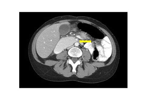 Superior Mesenteric Artery Syndrome - The Clinical Advisor