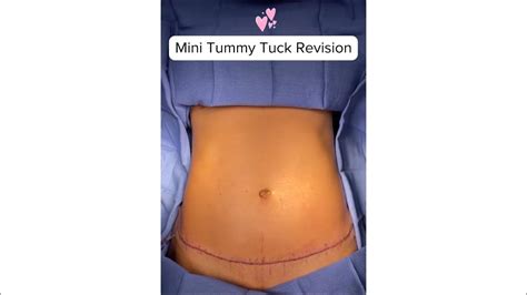 Mini Tummy Tuck Revision - YouTube