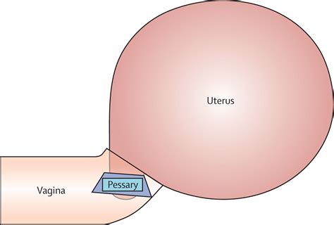 Cervical pessary in pregnant women with a short cervix (PECEP): an open ...