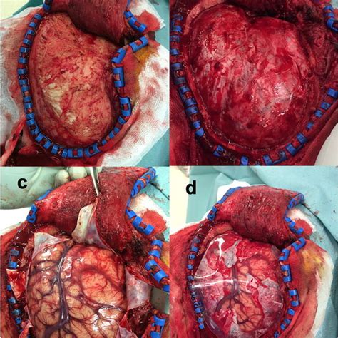 : Decompressive craniectomy complications. Brain herniation (a).... | Download Scientific Diagram