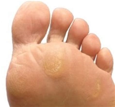 Callus Treatment | Healthcare-Online