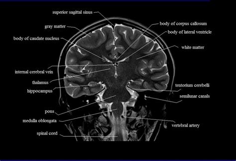 Get Anatomy Brain On Mri PNG