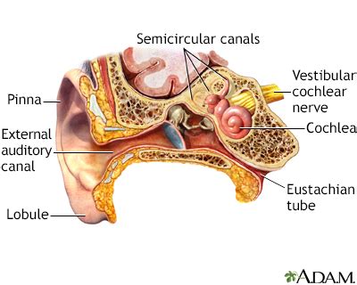 Benign ear cyst or tumor Information | Mount Sinai - New York