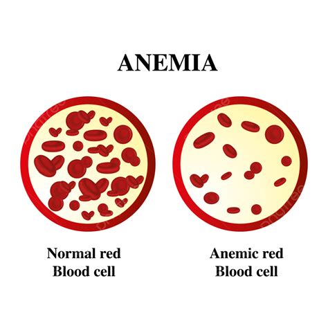 Anemia Iron Red Blood Cell Medical Vector Illustration, Anemia, Blood ...