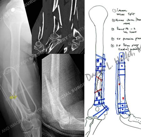 Humerus Fractures - Orthopedic Trauma Service