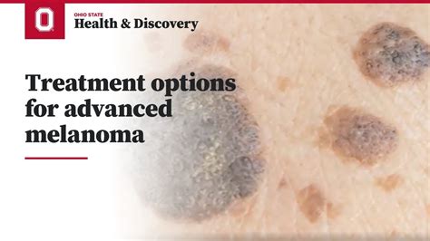 Treatment options for advanced melanoma | Ohio State Medical Center - YouTube