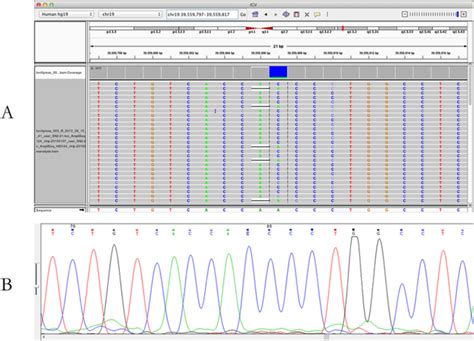 NGS data analyzed with IGV software (A) and Sanger sequencing data ...