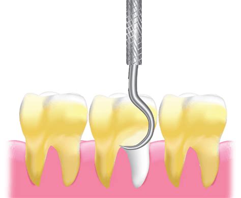 Dental Scaling And Polishing | AllSmiles Dental Care