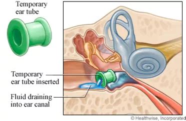 PE Tubes in Children: Professional Hearing Center: Audiologists