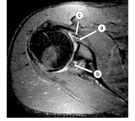 Anterior and Posterior Labrum Lesion. MRI proton density weighted fat... | Download Scientific ...