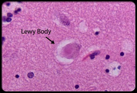 Lewy Body Dementia - USMLE Strike