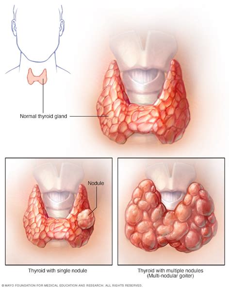 Thyroid nodules - Symptoms and causes - Mayo Clinic