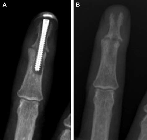 The Management of Complications of Small Joint Arthrodesis and ...