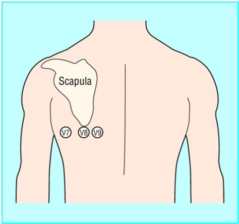 emDOCs.net – Emergency Medicine EducationECG Pointers: Posterior MI - emDOCs.net - Emergency ...