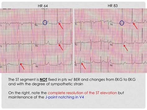 Benign Early Repolarization