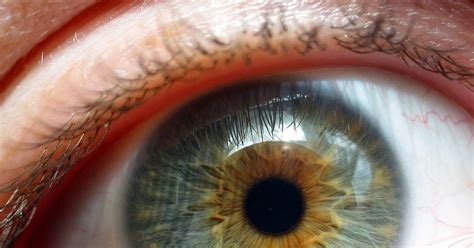 Keratoconus Treatment Options | 2+ surgeries in the past year